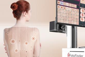 egészség, bőrrák, diagnosztika